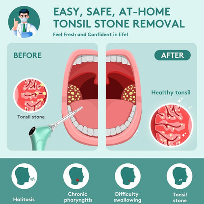 Tonsil Stone Remover Electric Vacuum Kit — Built-In LED Light, 3 Suction Modes, 5X Magnifying Mirror, Oral Irrigator for Effective Tonsil Stone Removal at Home